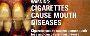 Smoking Causes Mouth Diseases